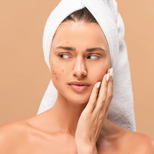 Akne ve Siyah Noktalar: Cilt Kusurları ile Baş Etmenin Doğal Yolları